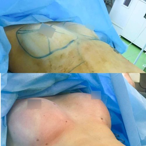 Липофилинг груди, сразу после операции