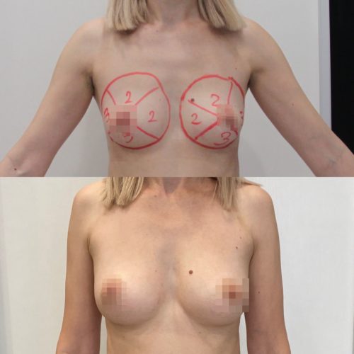 Липосакция поясницы, галифе, липофилинг груди, спустя 1 год