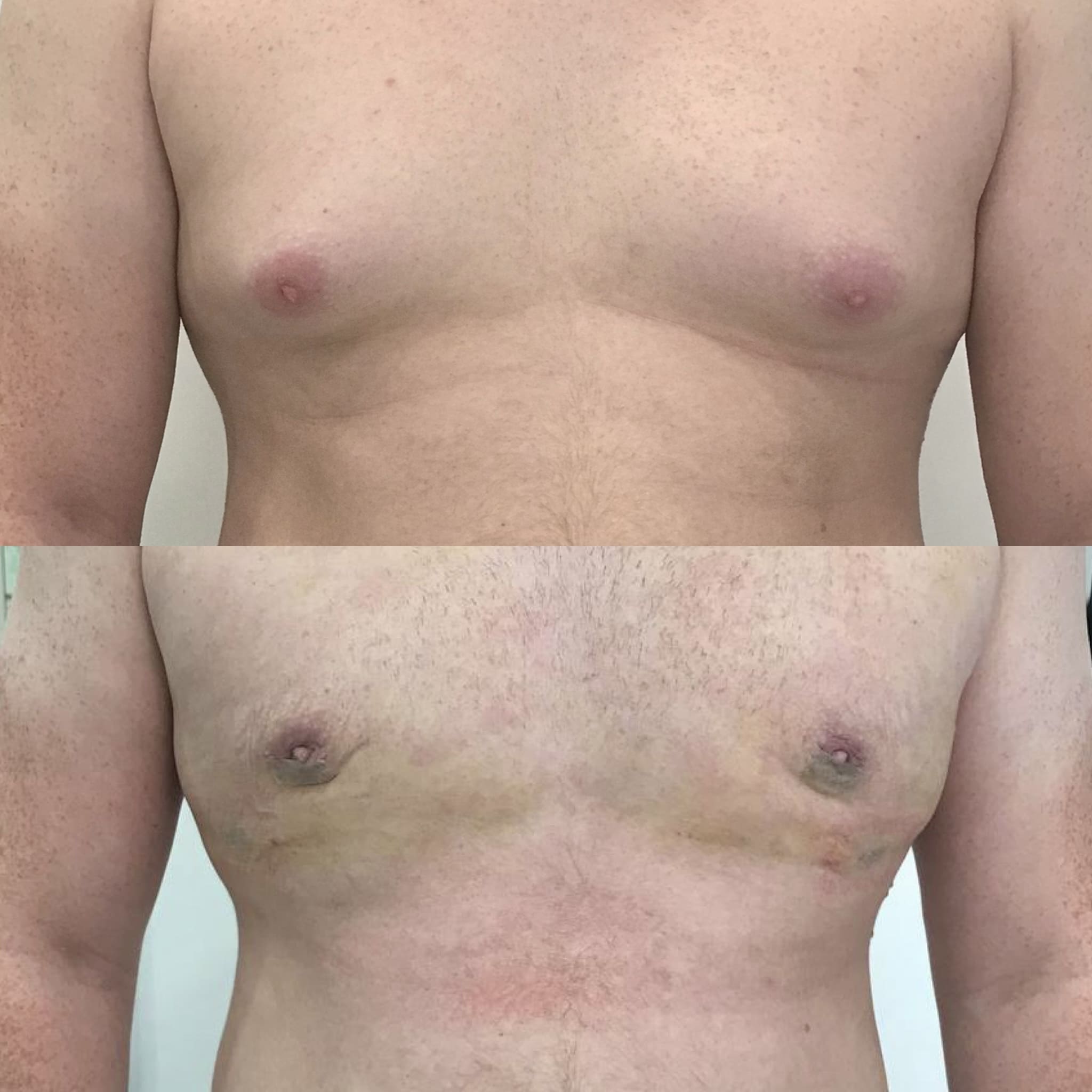 гормоны которые увеличивают грудь у мужчин фото 26