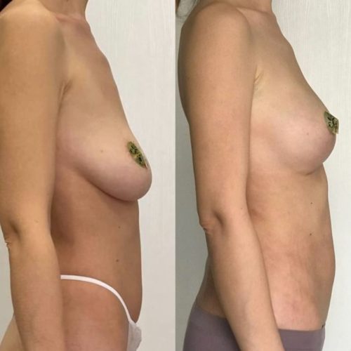 Подтяжка груди с липофилингом, спустя 1 месяц