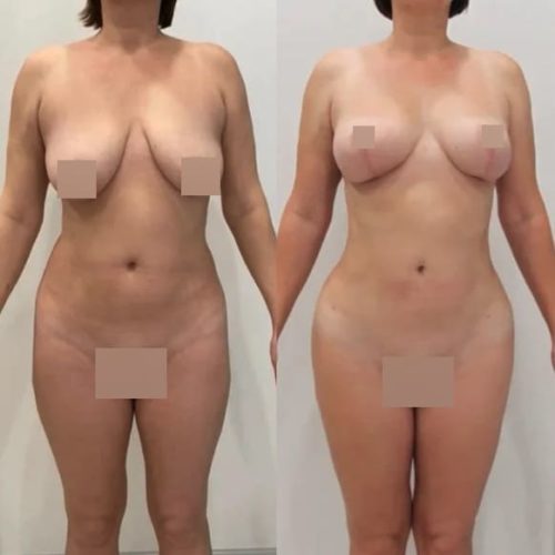 Редукция груди, липофилинг груди, липосакция галифе, поясницы, спустя 2,5 месяца