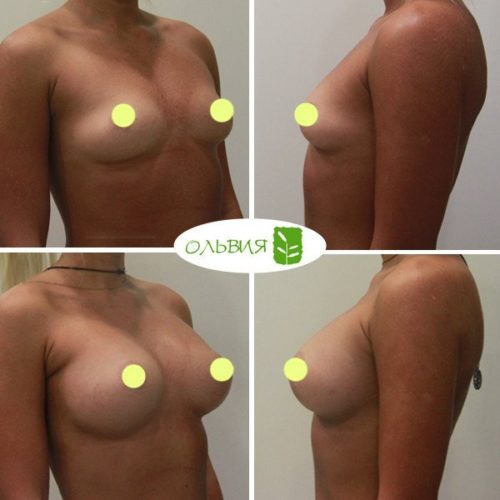 Эндоскопическое увеличение груди, Nagor 375гр , спустя 1 месяц