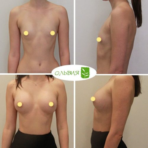 Эндоскопическое увеличение груди Nagor 375гр, спустя 3,5 месяцев