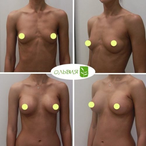 Эндоскопическое увеличение груди, Nagor анатомия 375гр, спустя 3 недели