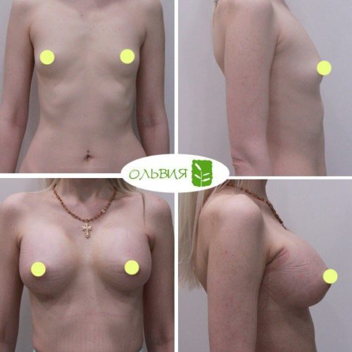 Эндоскопическое увеличение груди, SEBBIN 370гр