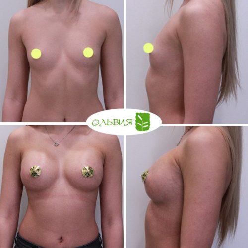 Эндоскопическое увеличение груди, SEBBIN 370гр
