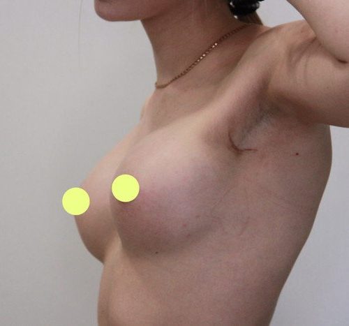 Эндоскопическое увеличение груди, импланты SEBBIN 280гр, спустя 3 месяца