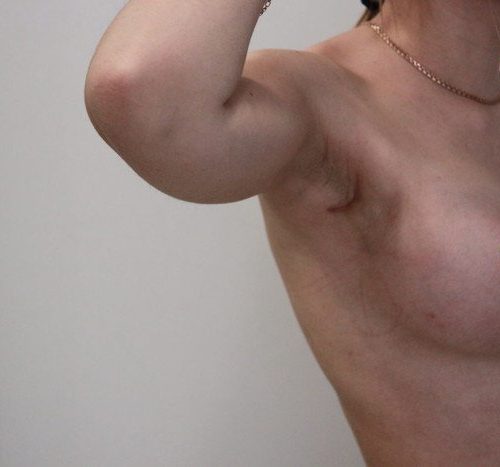 Эндоскопическое увеличение груди, импланты SEBBIN 280гр, спустя 3 месяца