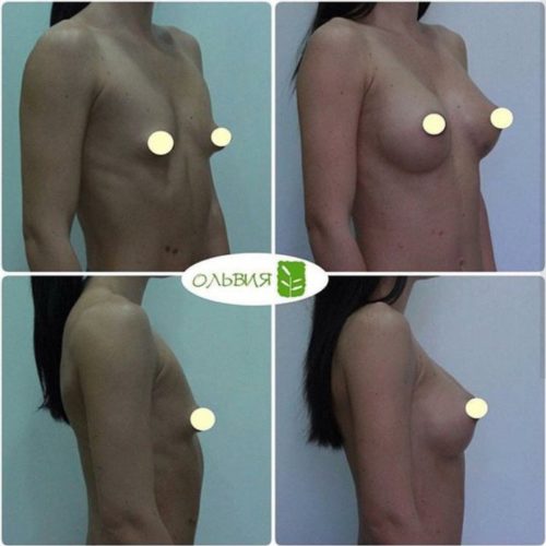 Эндоскопическое увеличение груди, спустя 2 месяца