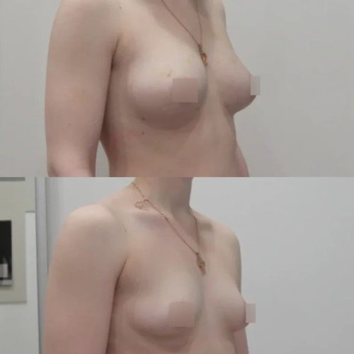 Липофилинг груди, спустя 1 месяц