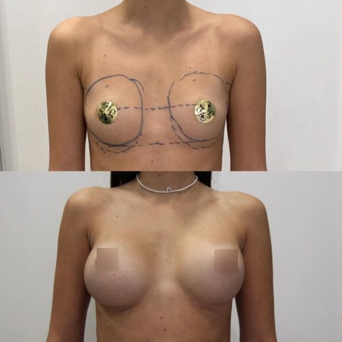 Трансаксиллярный доступ увеличения груди, импланты 325гр, спустя 1 год