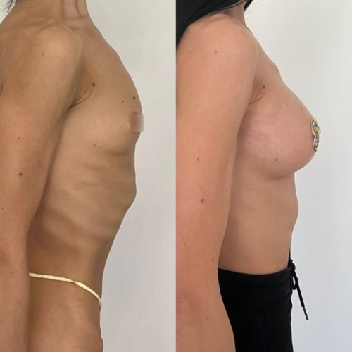 Увеличение груди имплантами 280гр, трансаксиллярный доступ, спустя 2 недели