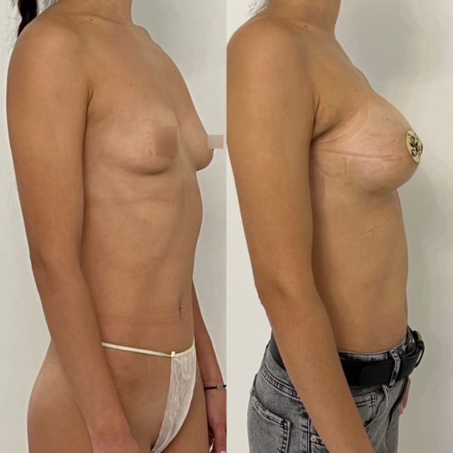 Увеличение груди имплантами 280гр, трансаксиллярный доступ, спустя 2 недели