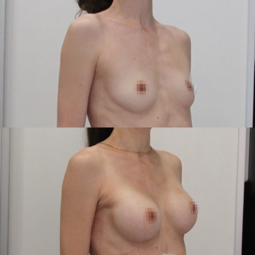 Увеличение груди имплантами 300гр трансаксиллярный доступ до и спустя 1 месяц