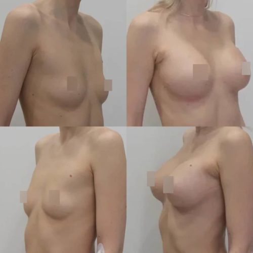 Увеличение груди имплантами 325 гр, трансаксиллярный доступ, спустя 1 месяц