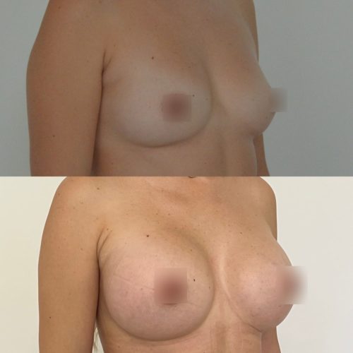 Увеличение груди имплантами 325гр, трансаксиллярный доступ, спустя 2 месяца