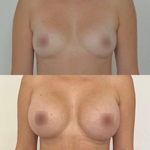 Увеличение груди имплантами 325гр, трансаксиллярный доступ, спустя 2 месяца