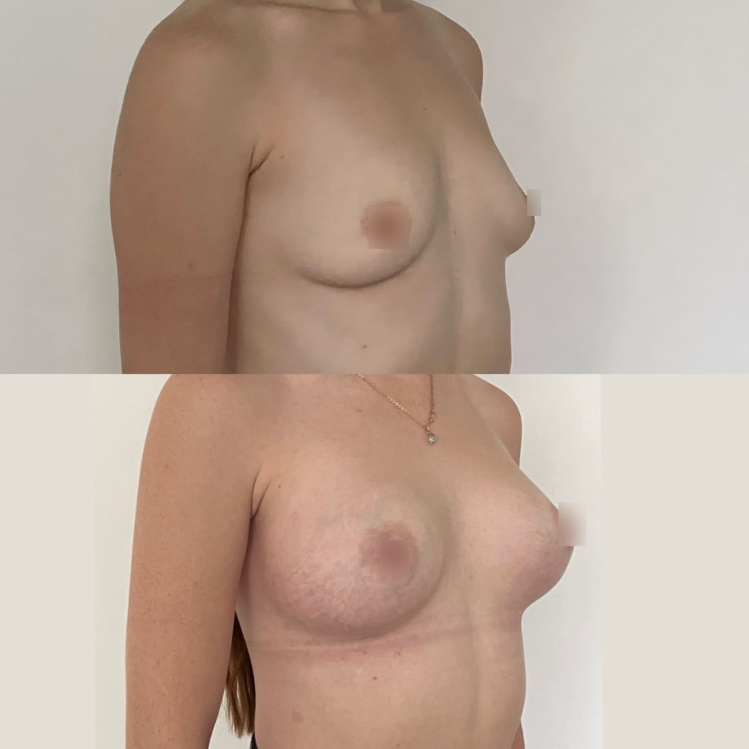 одна грудь опухла имплант фото 54