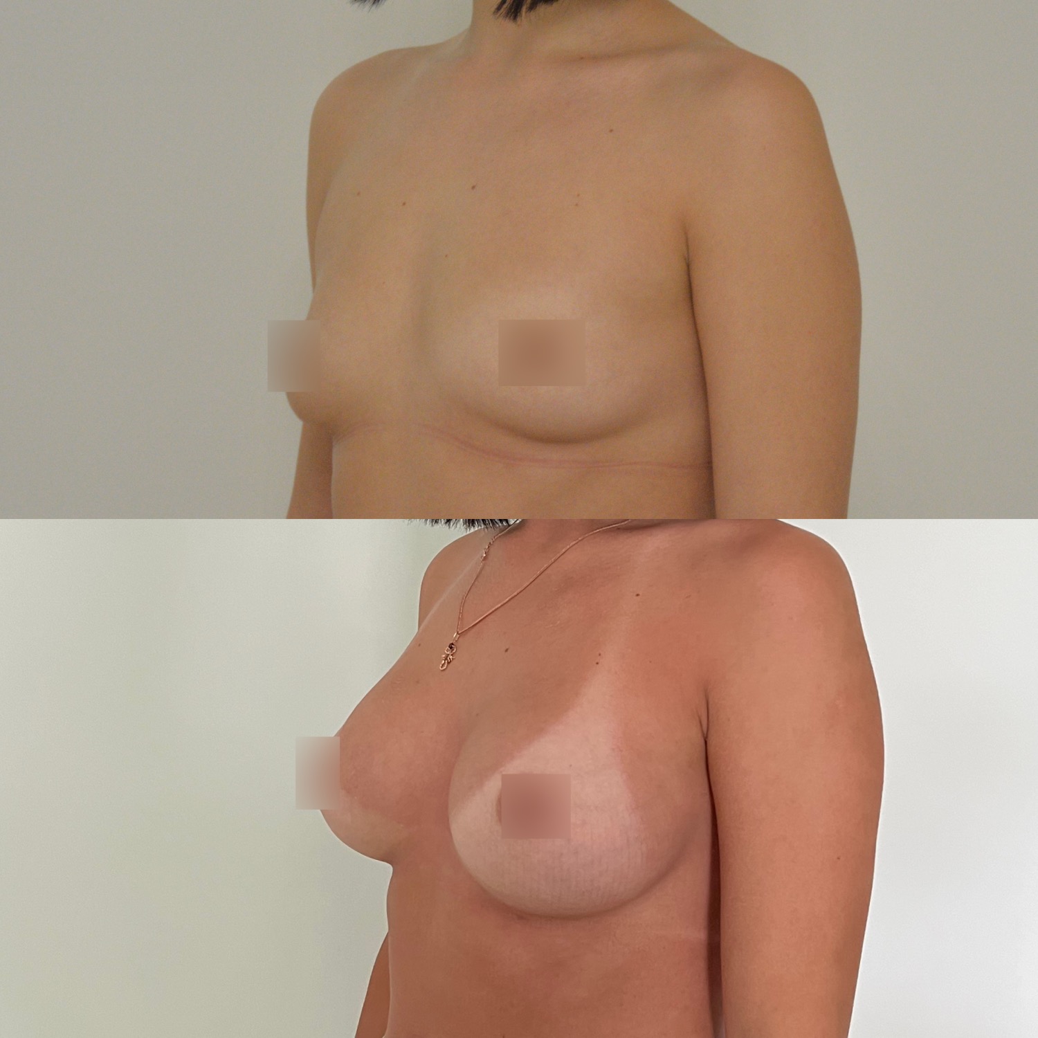 цена на силиконовую импланты грудь фото 95