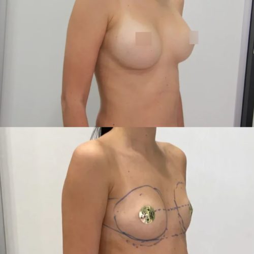 Увеличение груди имплантами 325гр, трансаксиллярный доступ, спустя 3 месяца