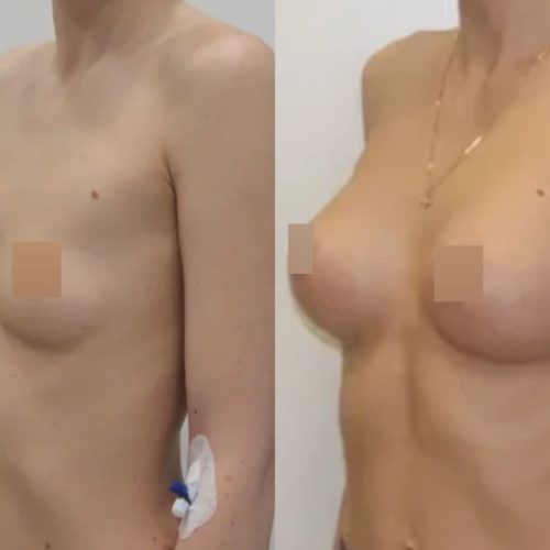 Увеличение груди имплантами 325гр, трансаксиллярный доступ, спустя 3 месяца