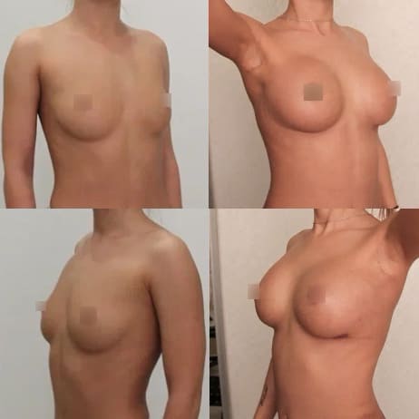 Увеличение груди имплантами, трансаксиллярный доступ, 235гр, спустя 11 дней