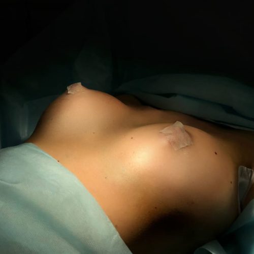 Увеличение груди имплантами, трансаксиллярный доступ, 325гр