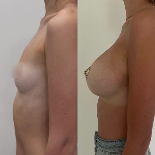 Увеличение груди, трансаксиллярный доступ, импланты 335гр, спустя 1 год